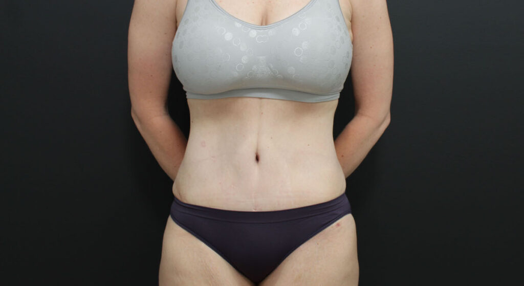 After Photo of Tummy Tuck Patient
