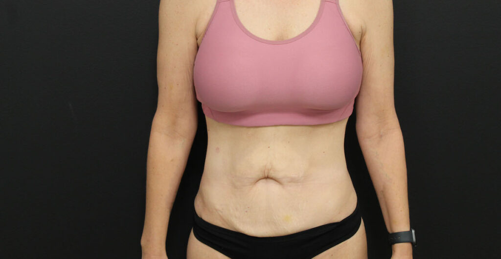 Before Photo of Tummy Tuck Patient